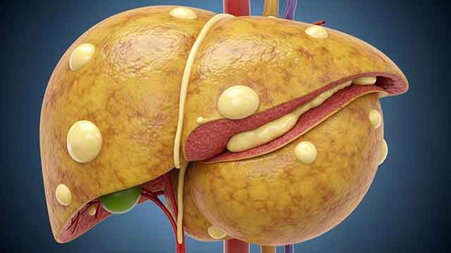 지방간 없애는 효과적인 방법: 간 건강을 지키는 생활습관과 식단 가이드